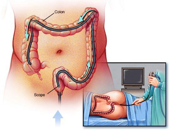 หัวข้อ: คำแนะนำเรื่องอาหารหลังการตรวจส่องกล้องลำไส้ใหญ่ – กินอะไรได้ กินอะไรไม่ได้?